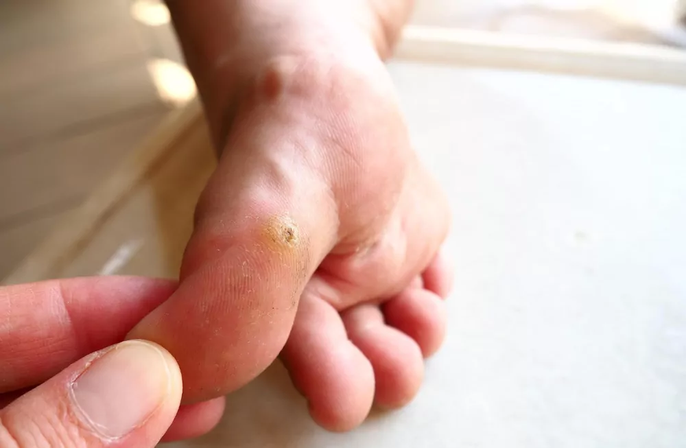 brodawka-wirusowa-kurzajka