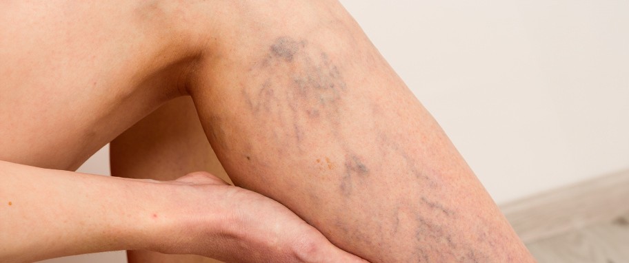 pajączki-żylne-centrum-medyczne-medici