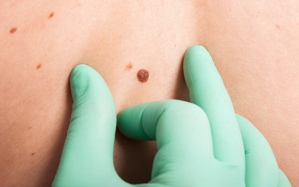 biopsja-skóry-centrum-medyczne-medici-radzionków