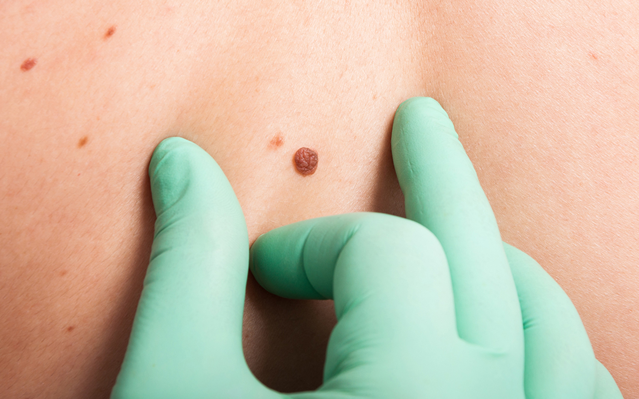 biopsja-skóry-centrum-medyczne-medici-radzionków