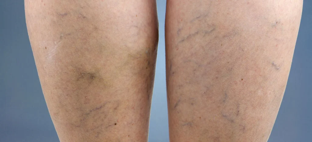 Laserowe Usuwanie Żylaków Bytom