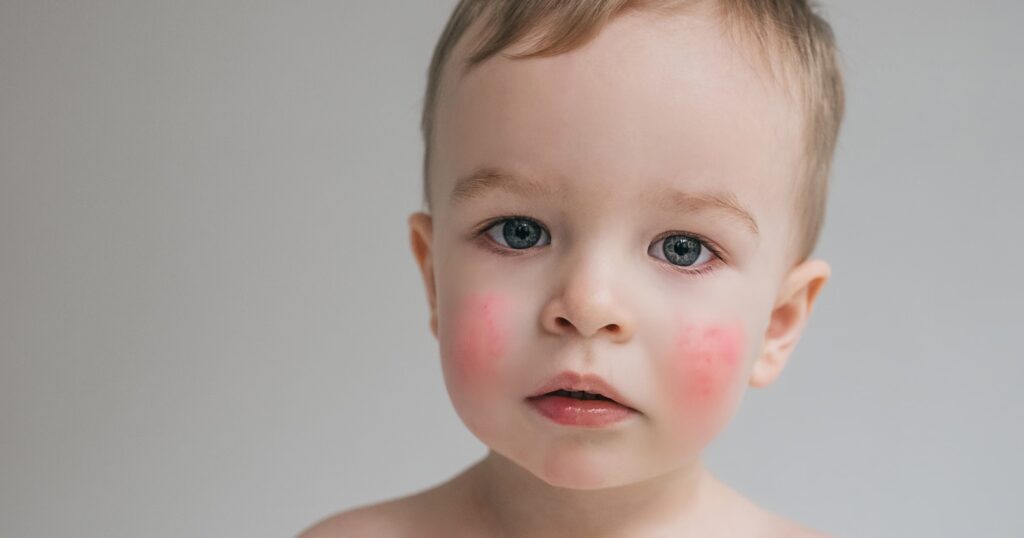 Nietolerancja bialka mleka krowiego u niemowlat i dzieci