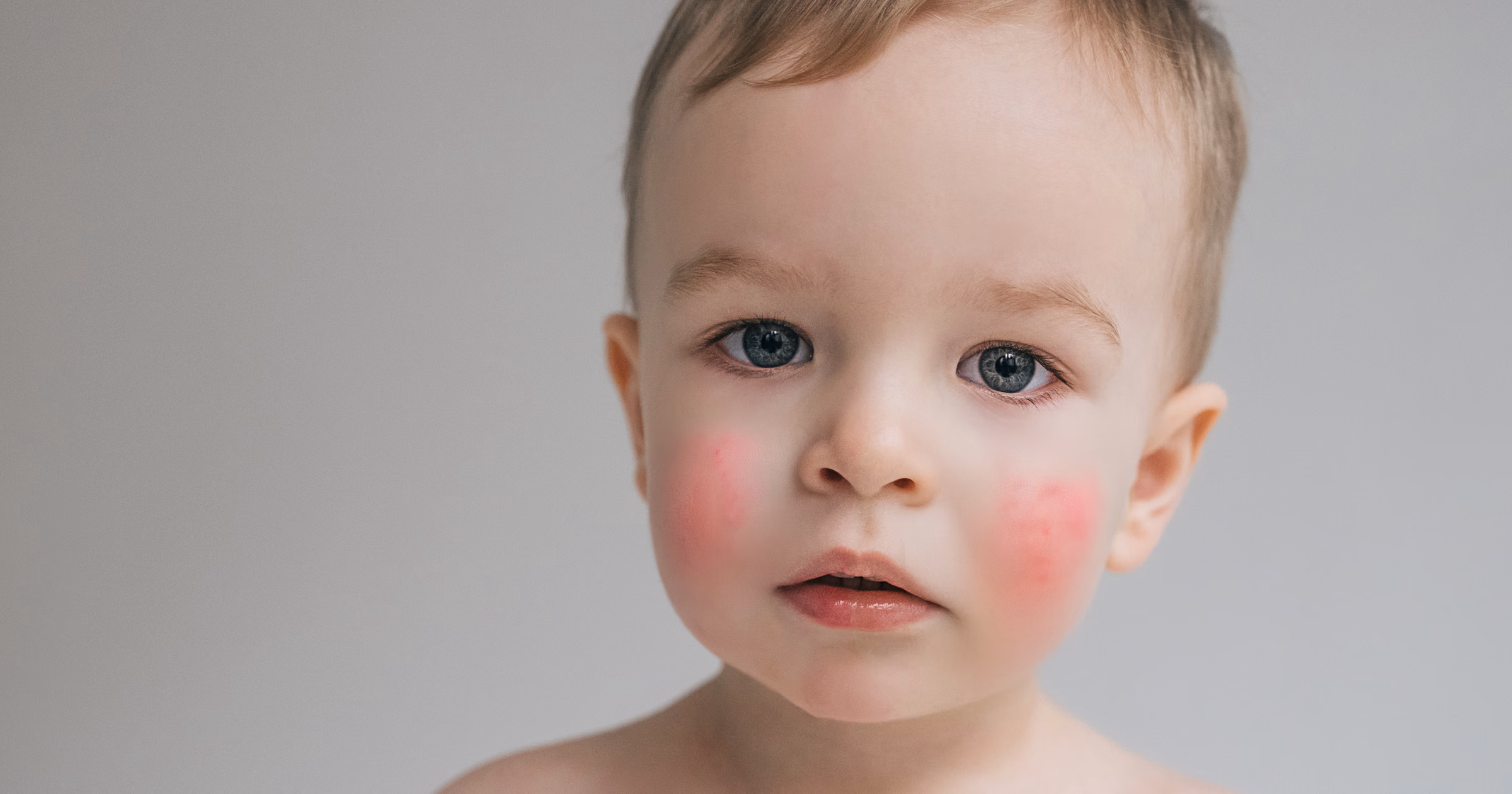 Nietolerancja bialka mleka krowiego u niemowlat i dzieci