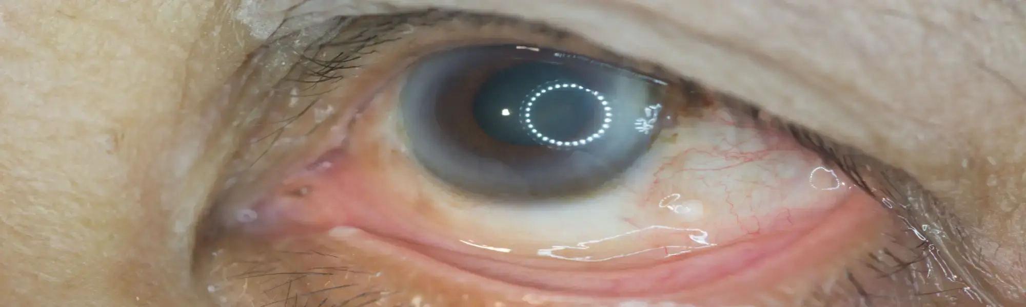 Retinopatia cukrzycowa