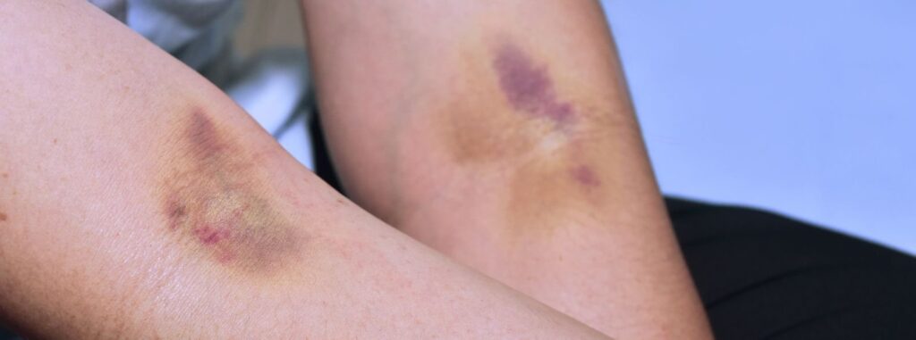 Choroba von Willebranda