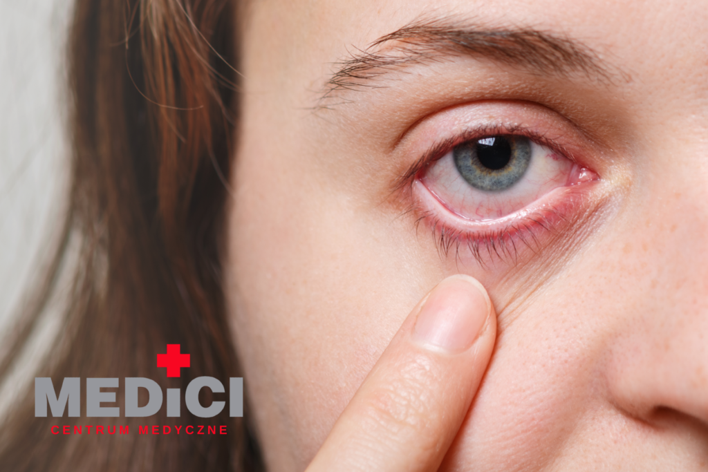 Zaczerwienione oko - jedna z możliwych objawów jaskry