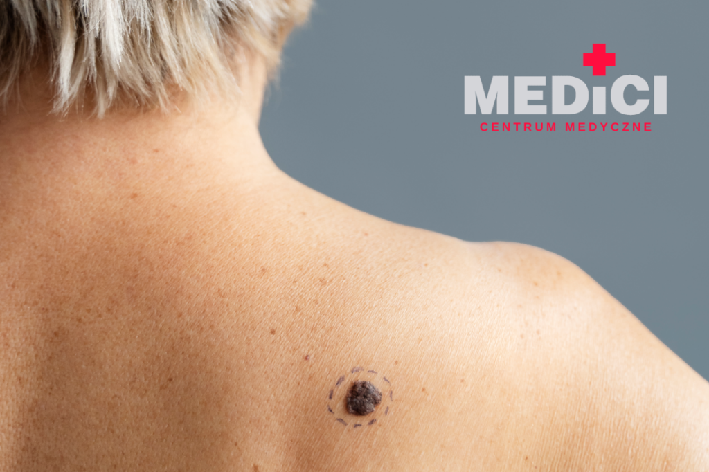 Krioterapia dermatologiczna